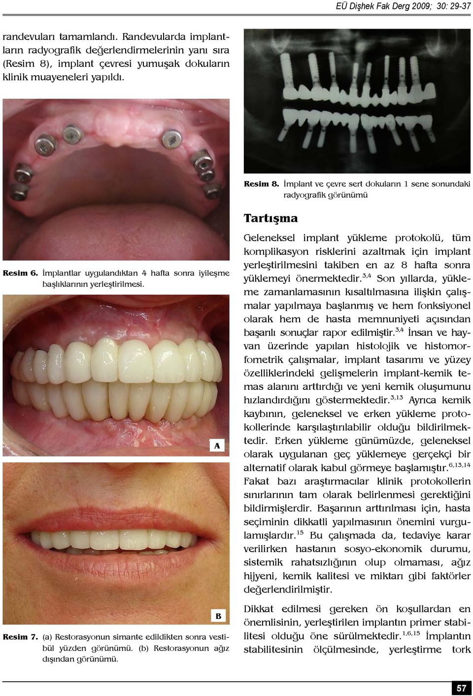 (a) Restorasyonun simante edildikten sonra vestibül yüzden görünümü. (b) Restorasyonun ağız dışından görünümü.