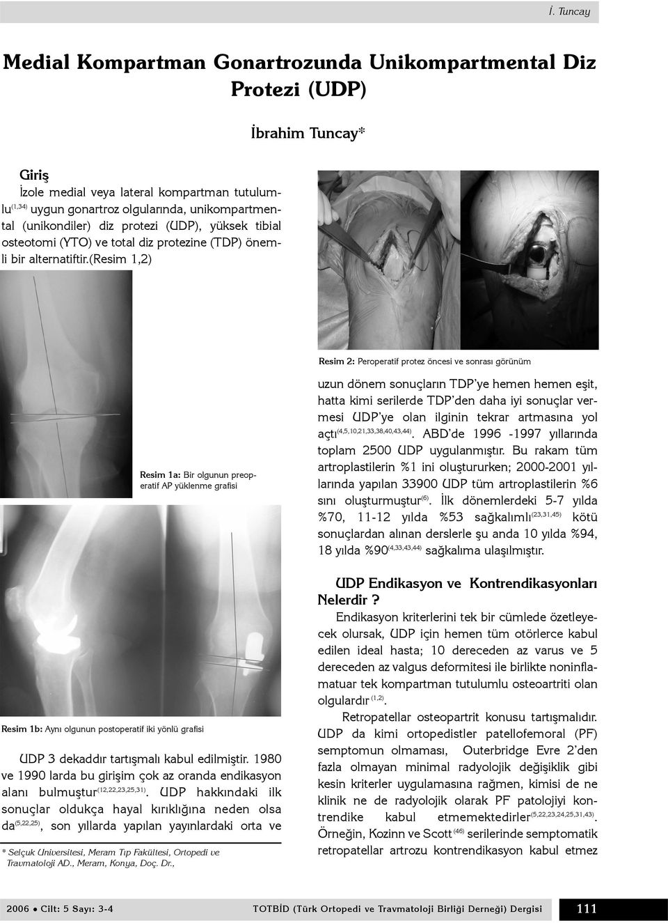 (resim 1,2) (1,34) Resim 2: Peroperatif protez öncesi ve sonrasý görünüm Resim 1a: Bir olgunun preoperatif AP yüklenme grafisi uzun dönem sonuçlarýn TDP ye hemen hemen eþit, hatta kimi serilerde TDP