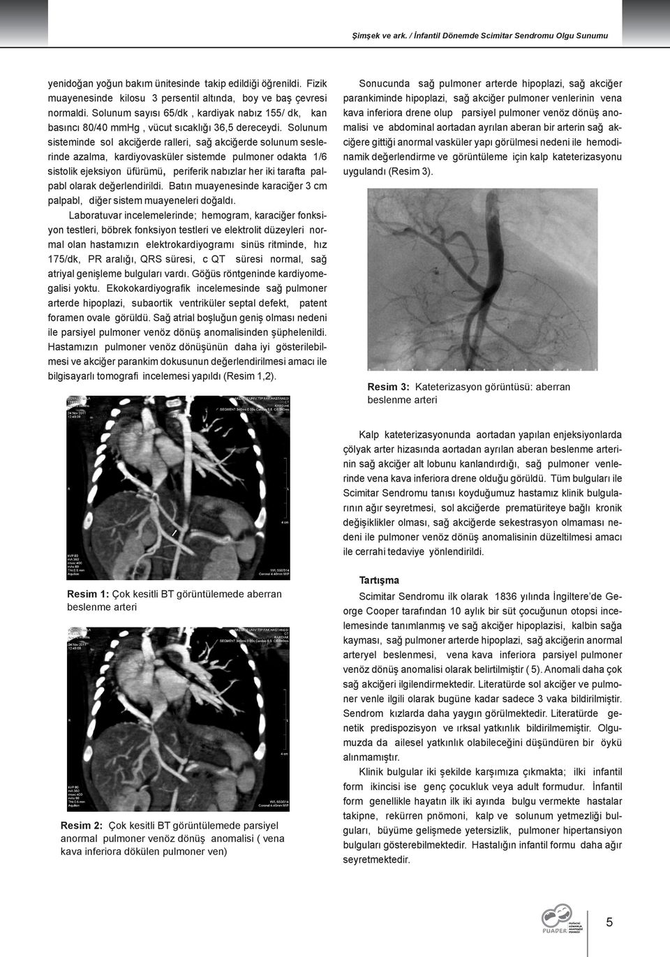 Solunum sisteminde sol akciğerde ralleri, sağ akciğerde solunum seslerinde azalma, kardiyovasküler sistemde pulmoner odakta 1/6 sistolik ejeksiyon üfürümü, periferik nabızlar her iki tarafta palpabl