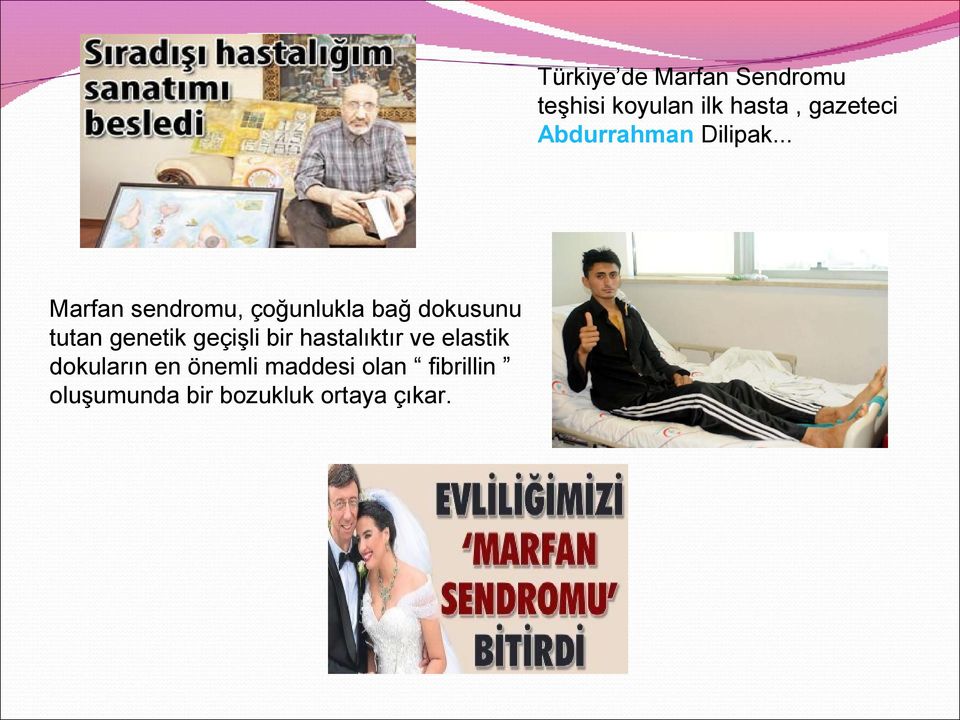 fibrillin oluşumunda bir bozukluk ortaya çıkar.