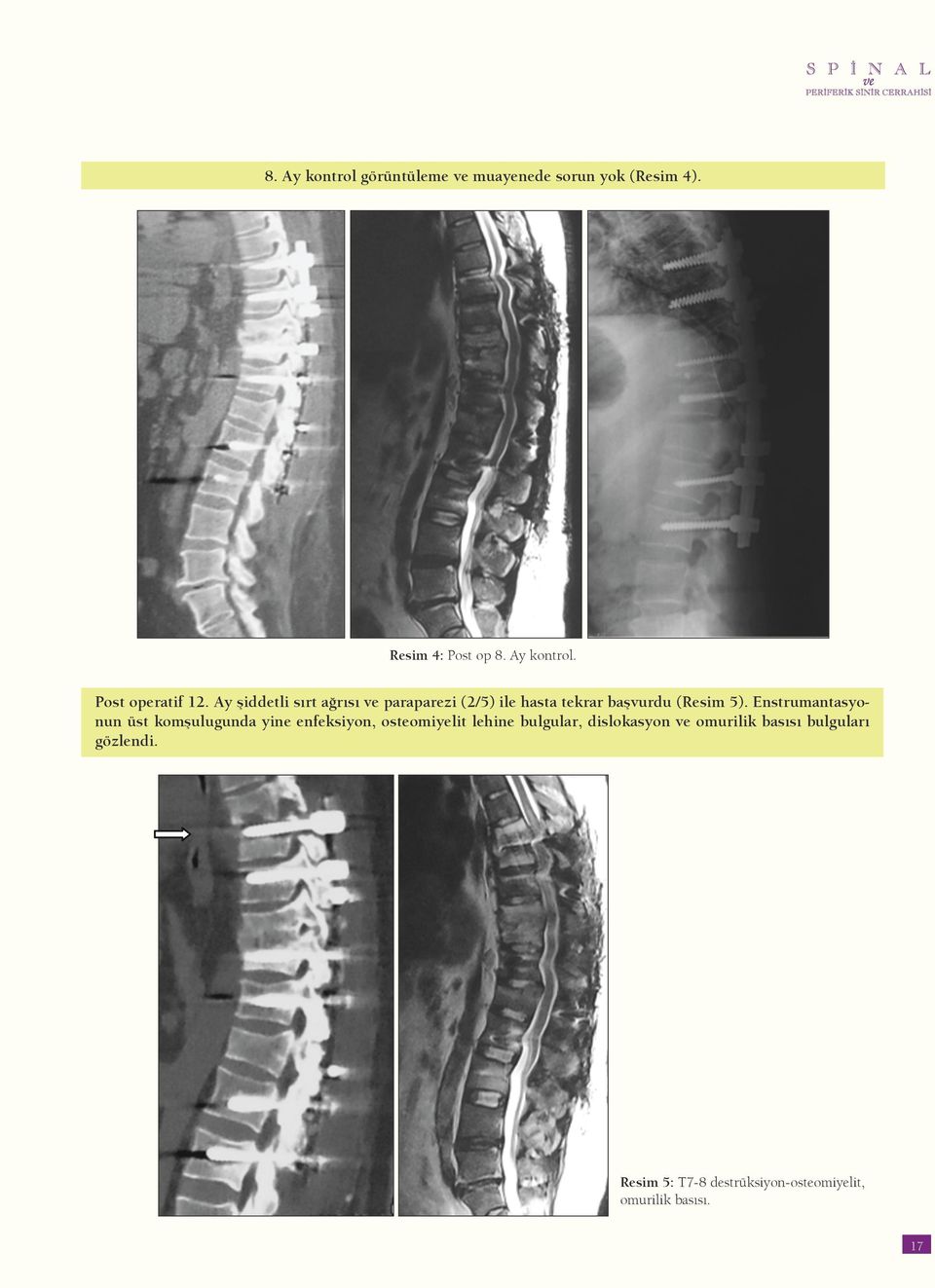 Enstrumantasyonun üst komşulugunda yine enfeksiyon, osteomiyelit lehine bulgular, dislokasyon