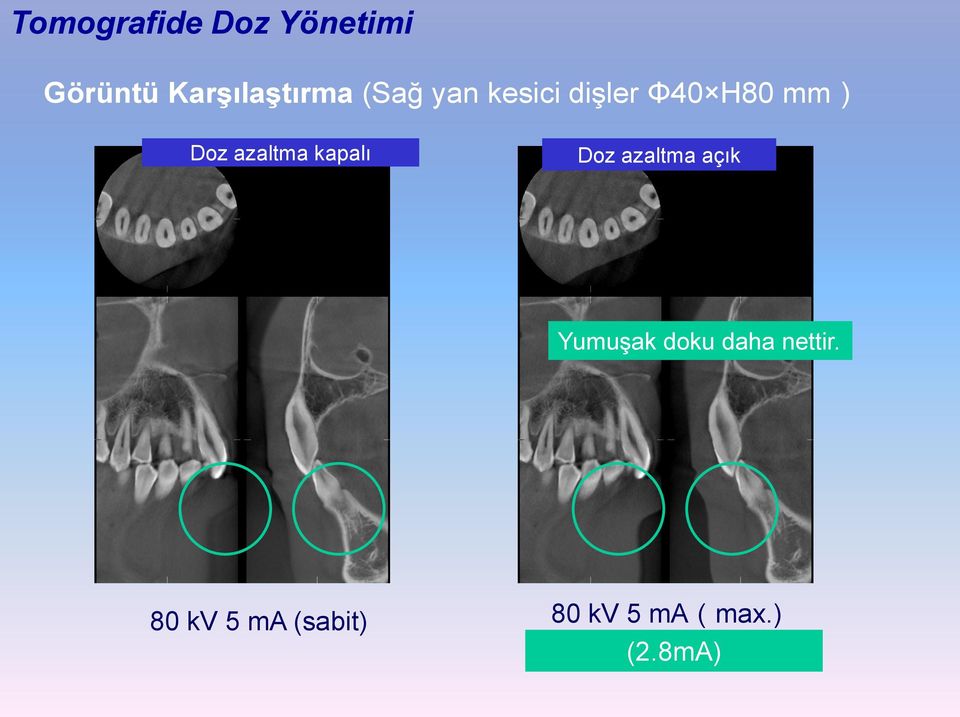 kapalı Doz azaltma açık Yumuşak doku daha