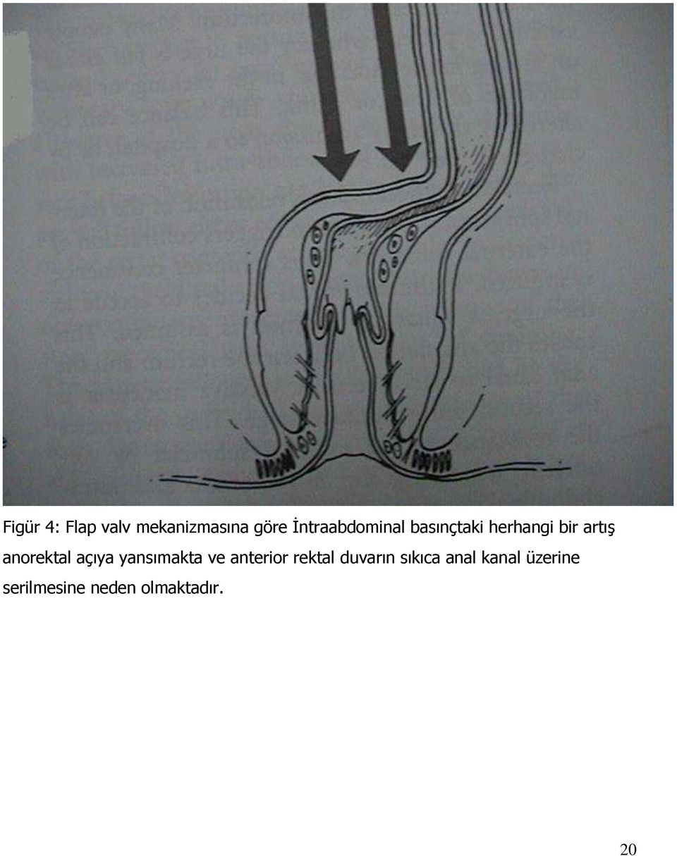 anorektal açıya yansımakta ve anterior rektal