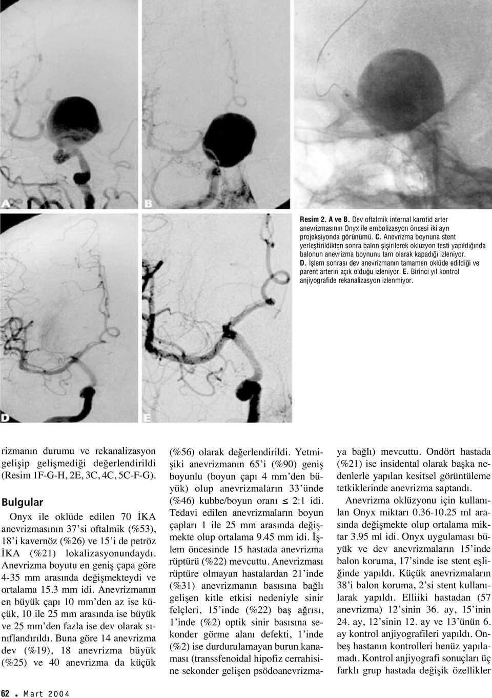 fllem sonras dev anevrizman n tamamen oklüde edildi i ve parent arterin aç k oldu u izleniyor. E. Birinci y l kontrol anjiyografide rekanalizasyon izlenmiyor.