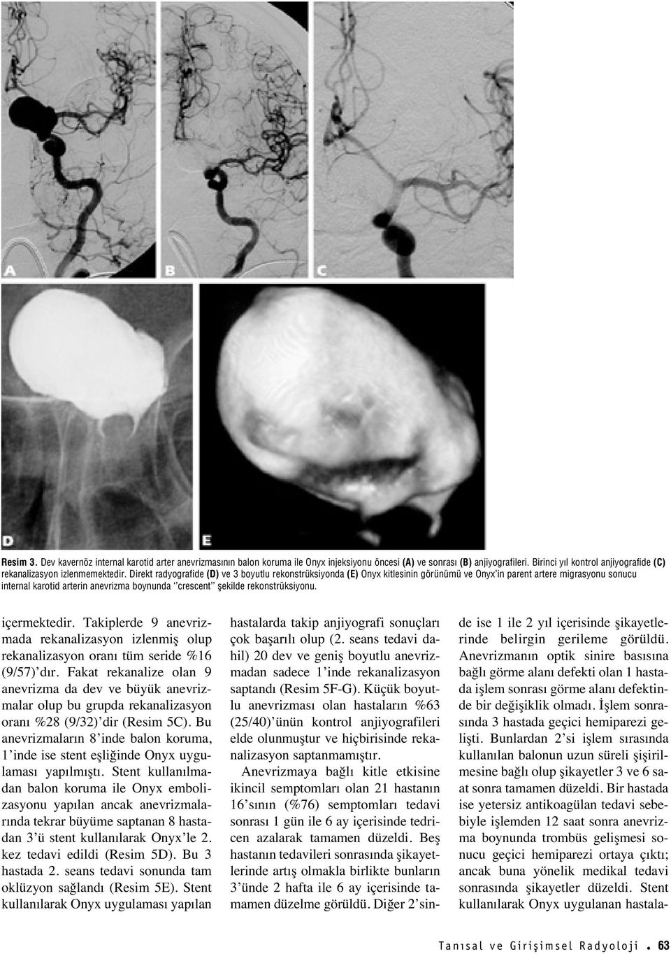 Direkt radyografide (D) ve 3 boyutlu rekonstrüksiyonda (E) Onyx kitlesinin görünümü ve Onyx in parent artere migrasyonu sonucu internal karotid arterin anevrizma boynunda crescent flekilde