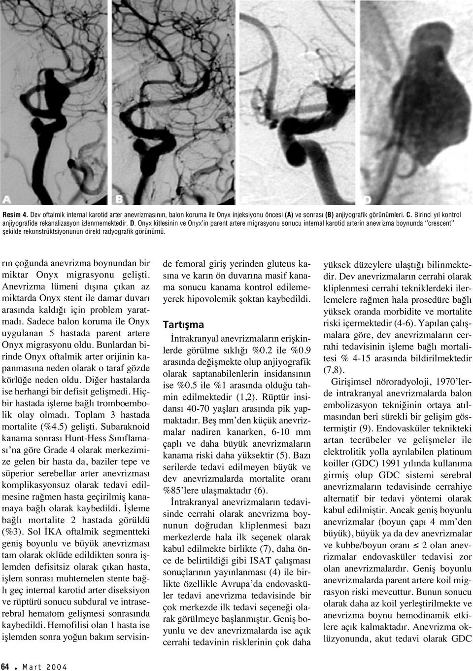 Onyx kitlesinin ve Onyx in parent artere migrasyonu sonucu internal karotid arterin anevrizma boynunda crescent flekilde rekonstrüktsiyonunun direkt radyografik görünümü.