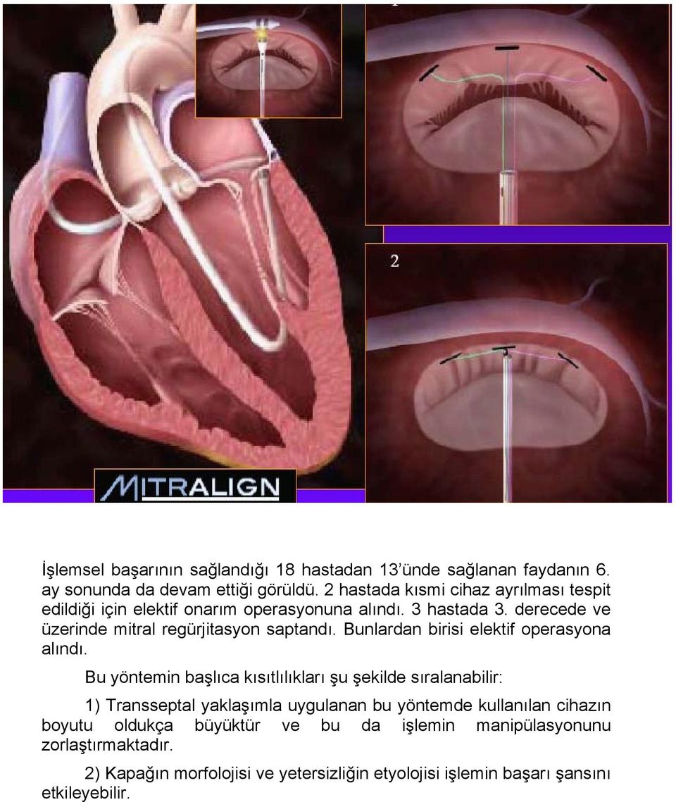 derecede ve üzerinde mitral regürjitasyon saptandı. Bunlardan birisi elektif operasyona alındı.