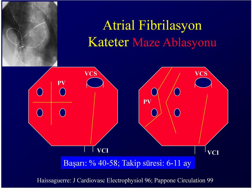 süresi: 6-11 ay VCI Haissaguerre: J