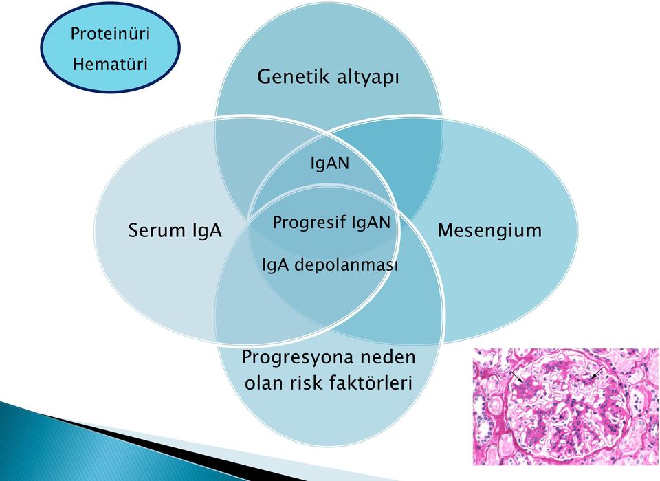 IgAN IgA depolanması Mesengium