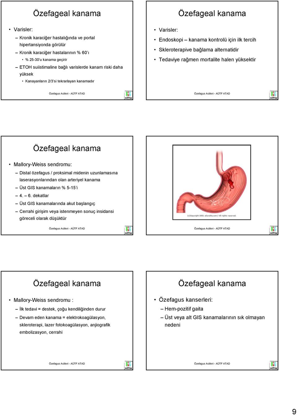 yüksektir Özefageal kanama Mallory-Weiss sendromu: Distal özefagus / proksimal midenin uzunlamasına laserasyonlarından olan arteriyel kanama Üst GIS kanamaların % 5-15 i 4. 6.