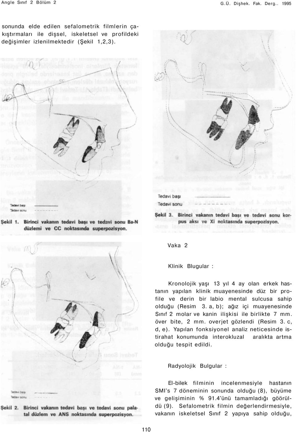 a, b); ağız içi muayenesinde Sınıf 2 molar ve kanin ilişkisi ile birlikte 7 mm. över bite, 2 mm. overjet gözlendi (Resim 3. c, d, e).