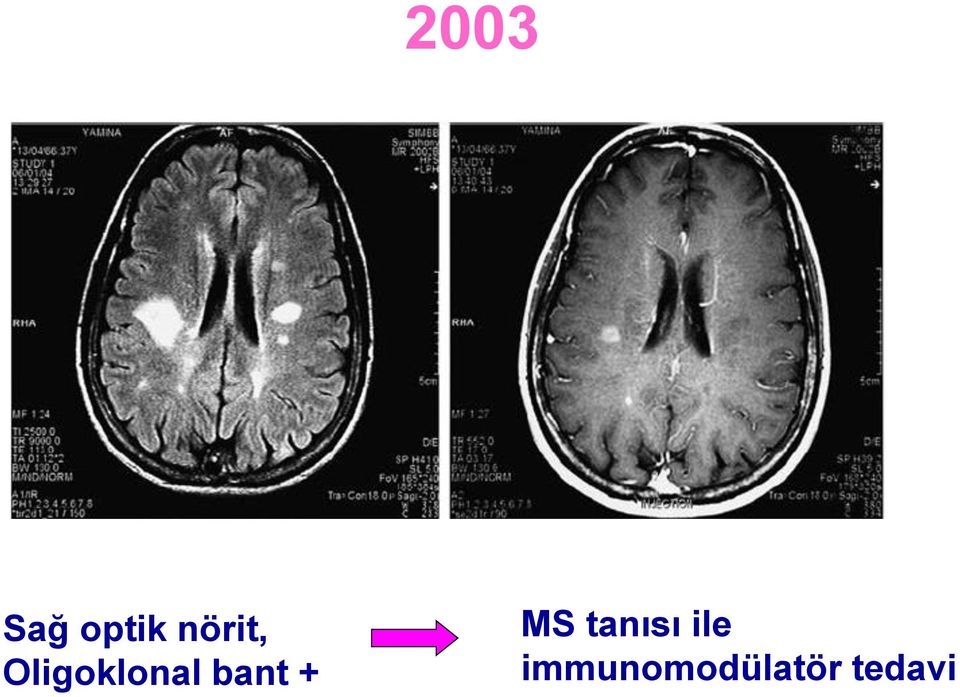 bant + MS tanısı