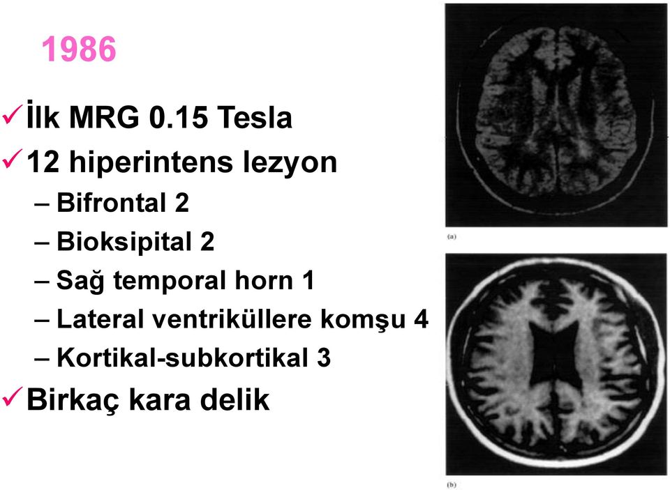 2 Bioksipital 2 Sağ temporal horn 1