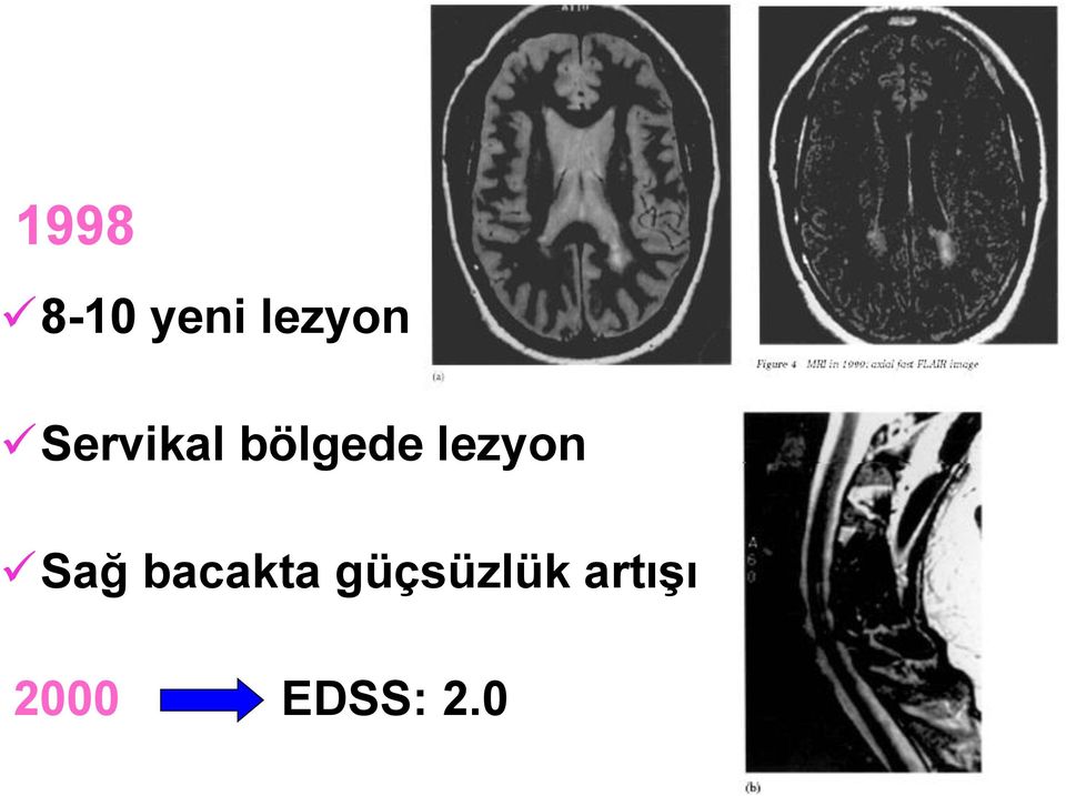 lezyon Sağ bacakta