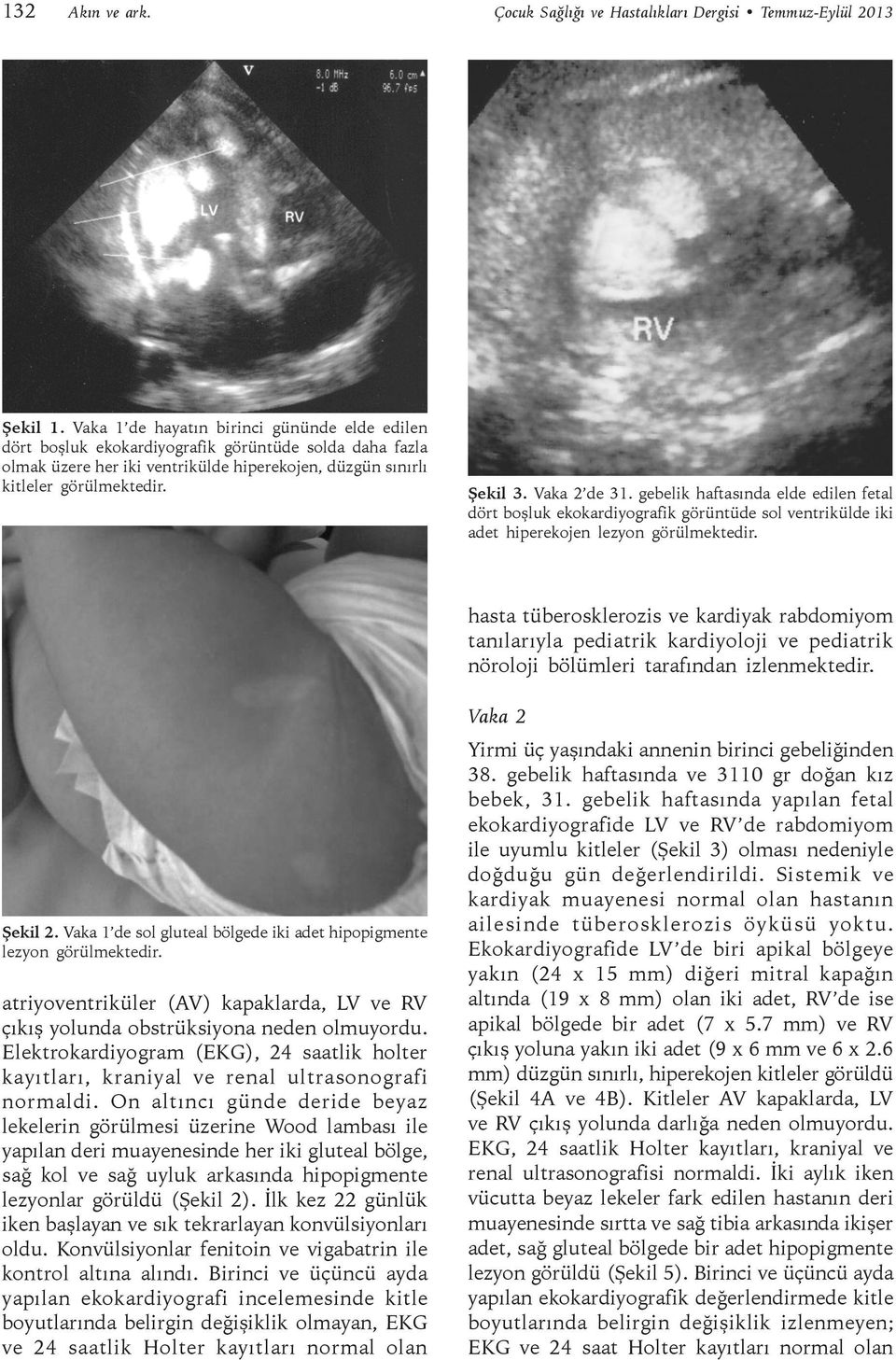 Çocuk Sağlığı ve Hastalıkları Dergisi Temmuz-Eylül 2013 Şekil 3. Vaka 2 de 31.