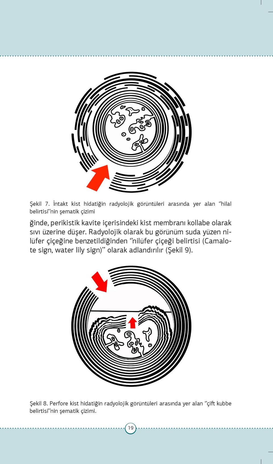 kavite içerisindeki kist membranı kollabe olarak sıvı üzerine düşer.