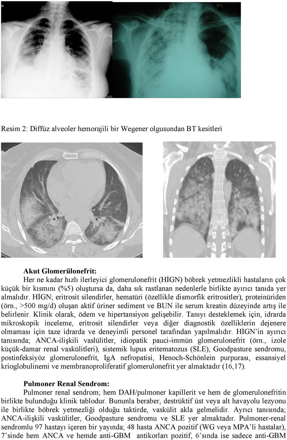 , >500 mg/d) oluşan aktif üriner sediment ve BUN ile serum kreatin düzeyinde artış ile belirlenir. Klinik olarak, ödem ve hipertansiyon gelişebilir.