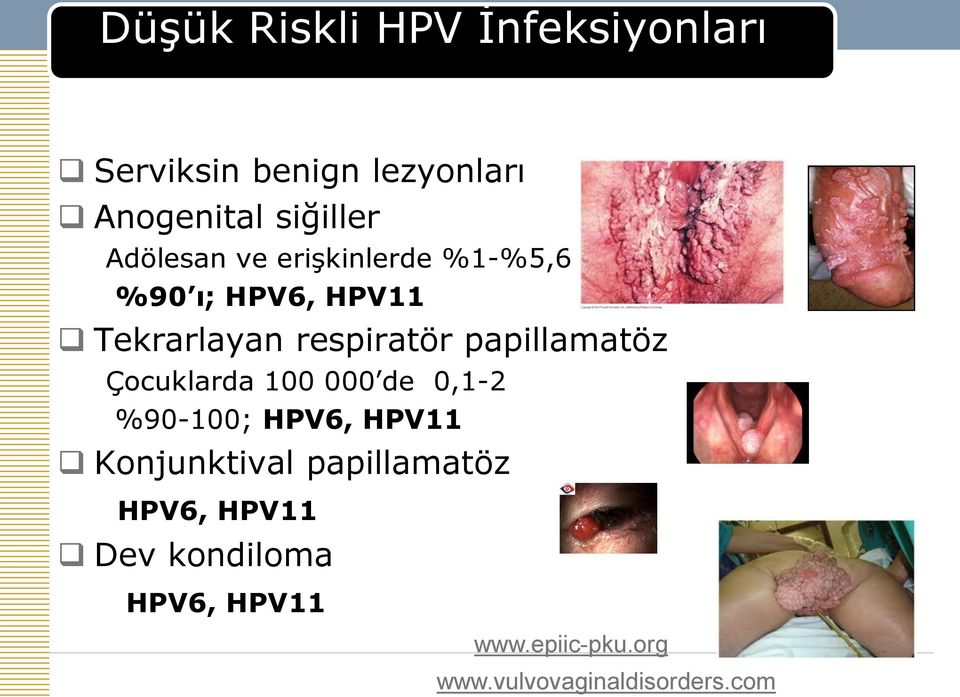 papillamatöz Çocuklarda 100 000 de 0,1-2 %90-100; HPV6, HPV11 Konjunktival