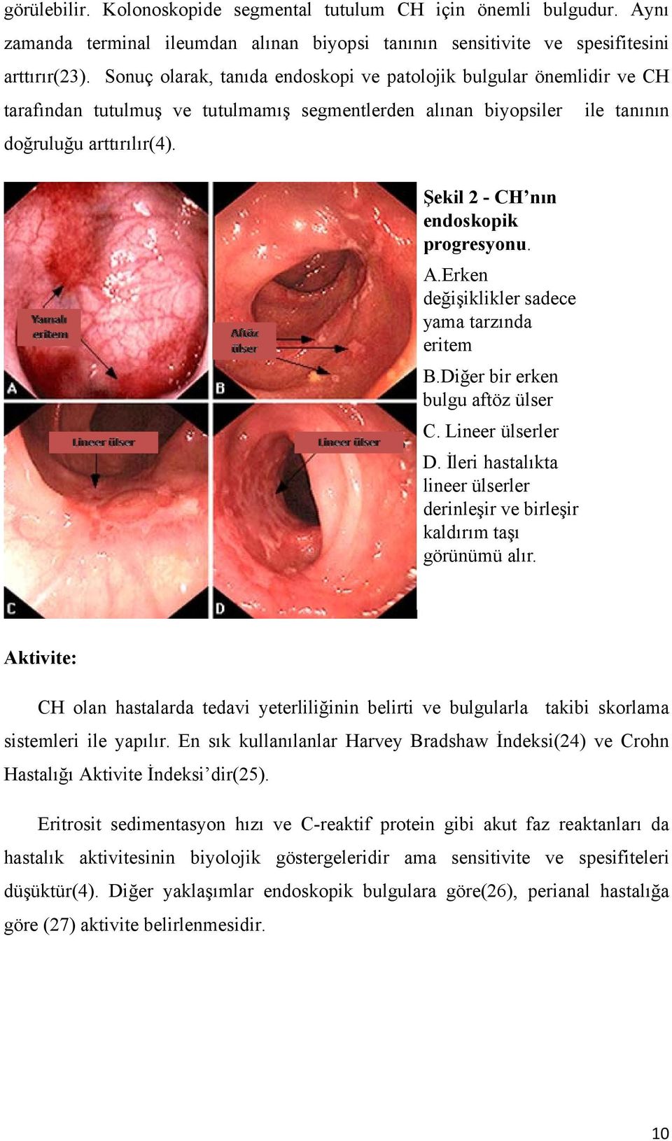 Şekil 2 - CH nın endoskopik progresyonu. A.Erken değişiklikler sadece yama tarzında eritem B.Diğer bir erken bulgu aftöz ülser C. Lineer ülserler D.