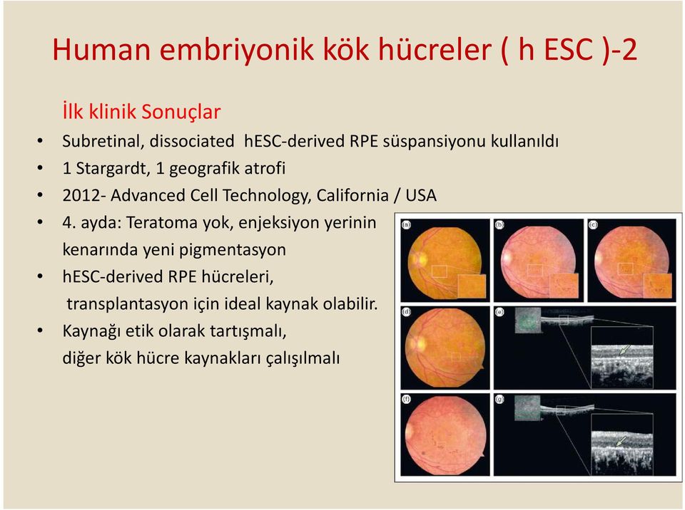 4. ayda: Teratoma yok, enjeksiyon yerinin kenarında yeni pigmentasyon hesc derived RPE hücreleri,