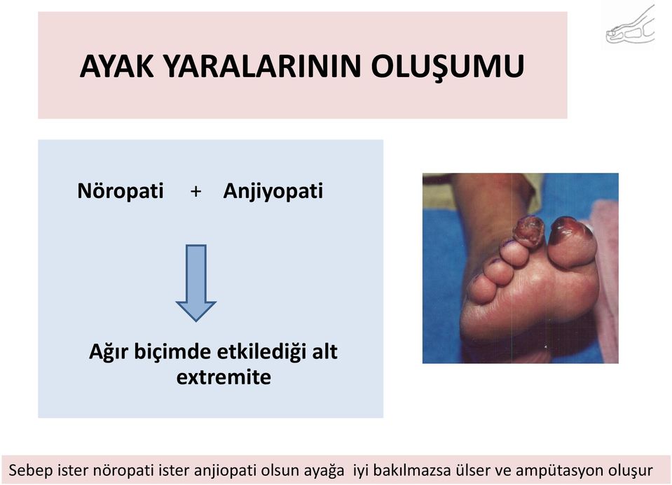 extremite Sebep ister nöropati ister