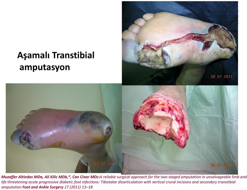 threatening acute progressive diabetic foot infections: Tibiotalar disarticulation with