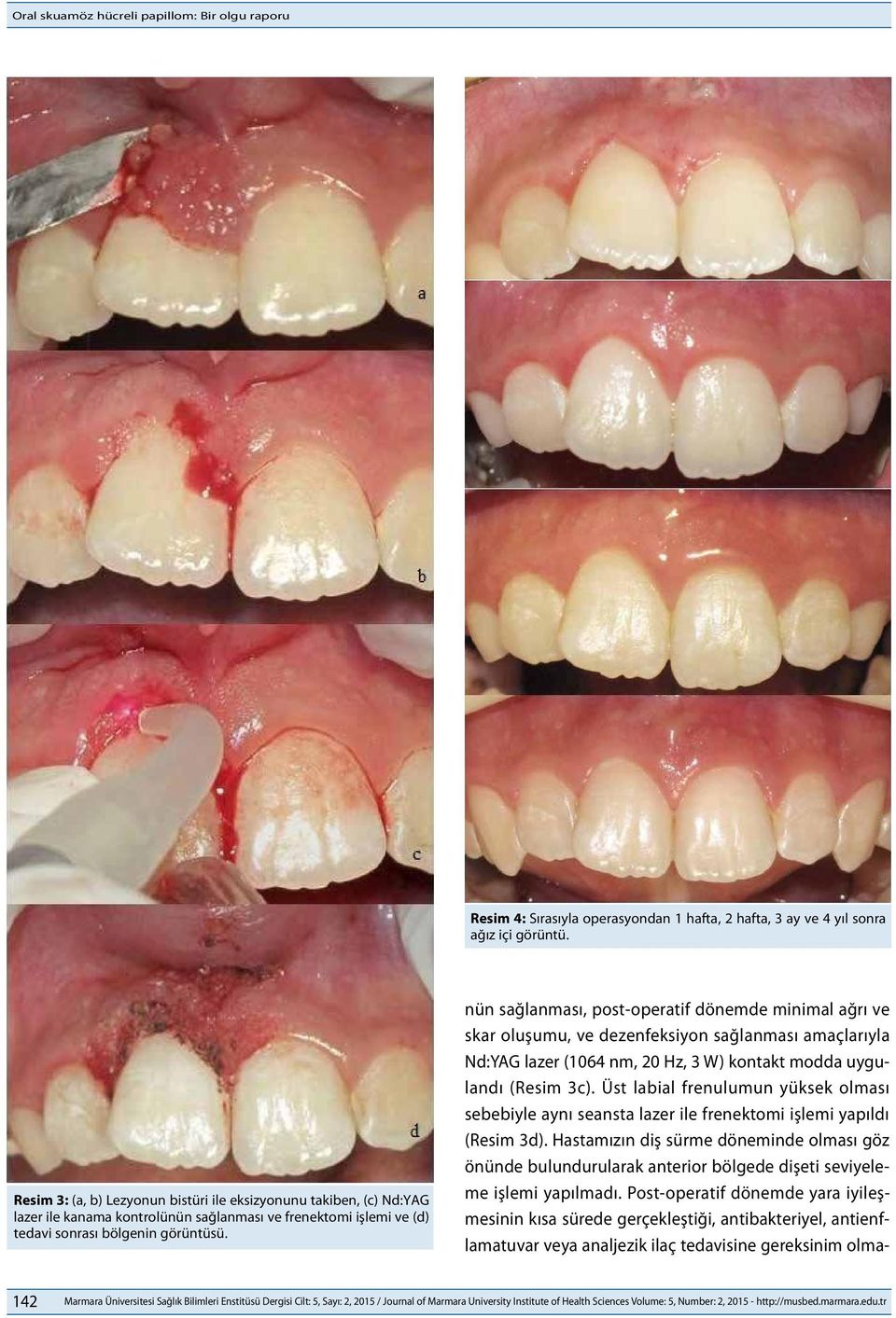 nün sağlanması, post-operatif dönemde minimal ağrı ve skar oluşumu, ve dezenfeksiyon sağlanması amaçlarıyla Nd:YAG lazer (1064 nm, 20 Hz, 3 W) kontakt modda uygulandı (Resim 3c).