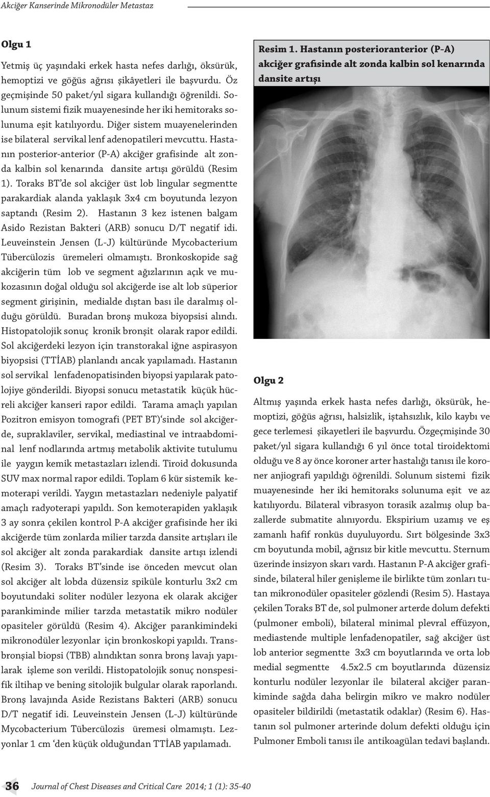 Diğer sistem muayenelerinden ise bilateral servikal lenf adenopatileri mevcuttu. Hastanın posterior-anterior (P-A) akciğer grafisinde alt zonda kalbin sol kenarında dansite artışı görüldü (Resim 1).