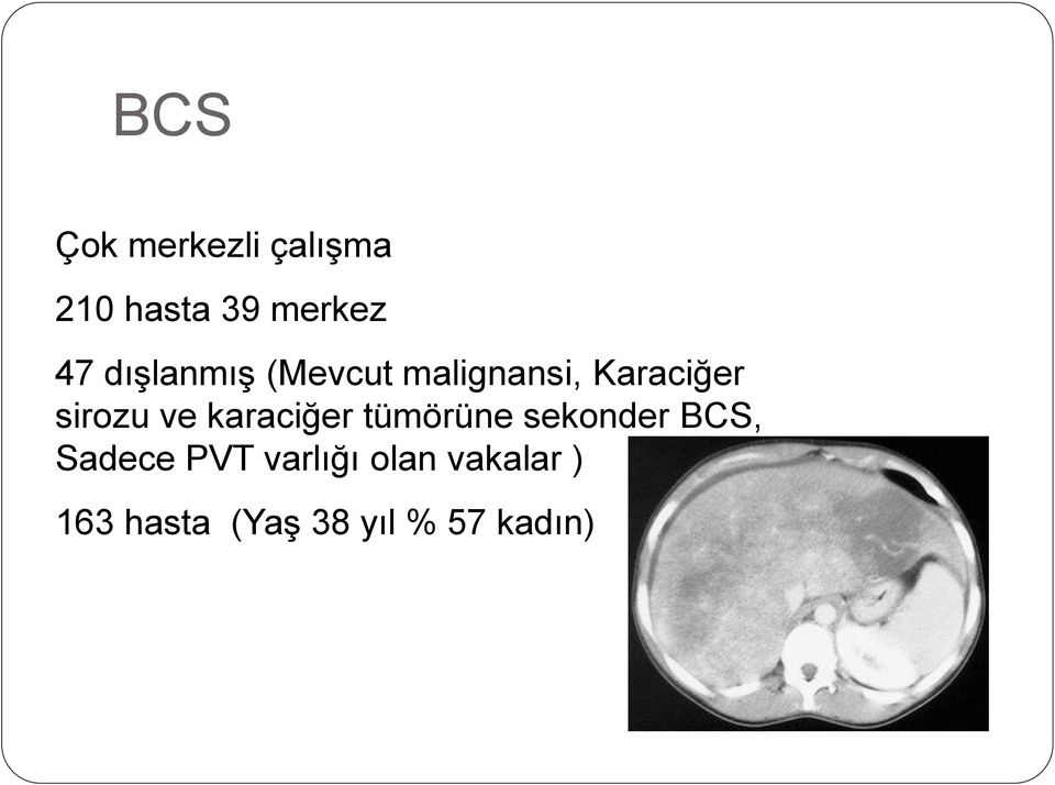 karaciğer tümörüne sekonder BCS, Sadece PVT