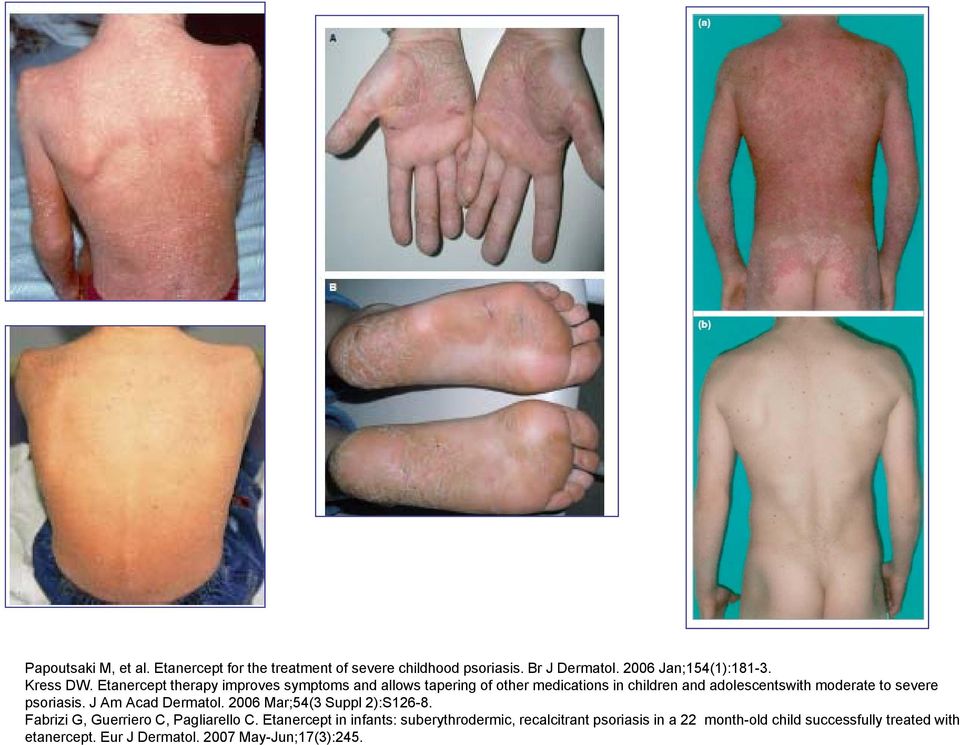 psoriasis. J Am Acad Dermatol. 2006 Mar;54(3 Suppl 2):S126-8. Fabrizi G, Guerriero C, Pagliarello C.