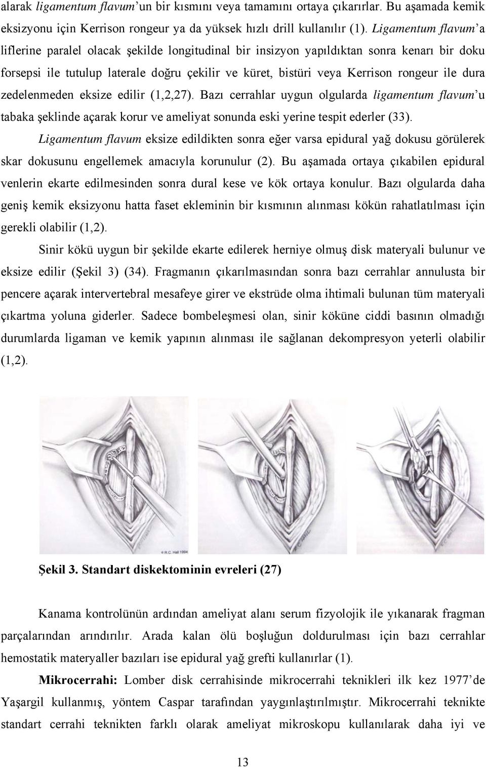 ile dura zedelenmeden eksize edilir (1,2,27). Bazı cerrahlar uygun olgularda ligamentum flavum u tabaka şeklinde açarak korur ve ameliyat sonunda eski yerine tespit ederler (33).