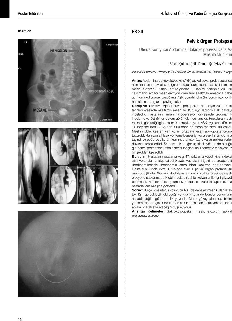 Üniversitesi Cerrahpaşa Tıp Fakültesi, Üroloji Anabilim Dalı, İstanbul, Türkiye Amaç: Abdominal sakrokolpopeksi (ASK) apikal duvar prolapsusunda altın standart tedavi olsa da görece olarak daha fazla