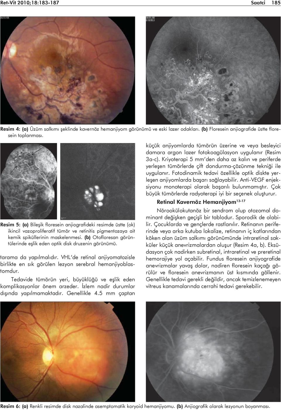 (b) Otofloresan görüntülerinde eşlik eden optik disk druzenin görünümü. tarama da yapılmalıdır. VHL de retinal anjiyomatozisle birlikte en sık görülen lezyon serebral hemanjiyoblastomdur.