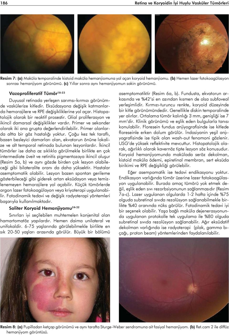 Vazoproliferatif Tümör 18-23 Duyusal retinada yerleşen sarımsı-kırmızı görünümde vaskülerize kitledir. Eksüdasyona değişik katmanlarda hemorajilere ve RPE değişikliklerine yol açar.