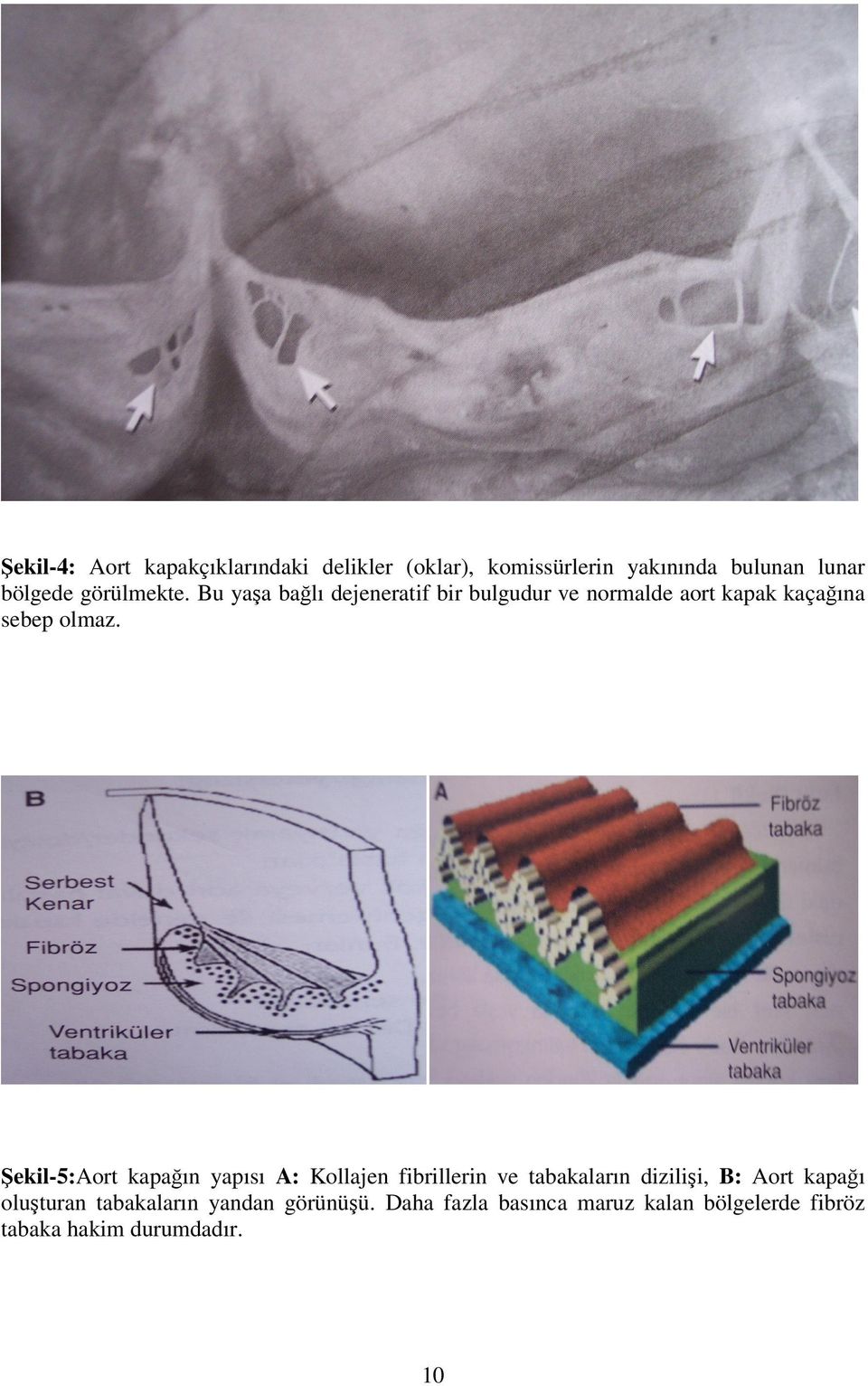 Şekil-5:Aort kapağın yapısı A: Kollajen fibrillerin ve tabakaların dizilişi, B: Aort kapağı