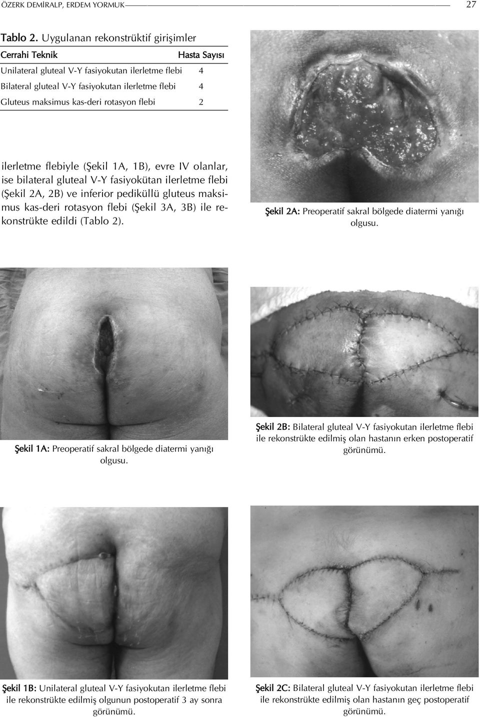 rotasyon flebi 2 ilerletme flebiyle (Şekil 1A, 1B), evre IV olanlar, ise bilateral gluteal V-Y fasiyokütan ilerletme flebi (Şekil 2A, 2B) ve inferior pediküllü gluteus maksimus kas-deri rotasyon