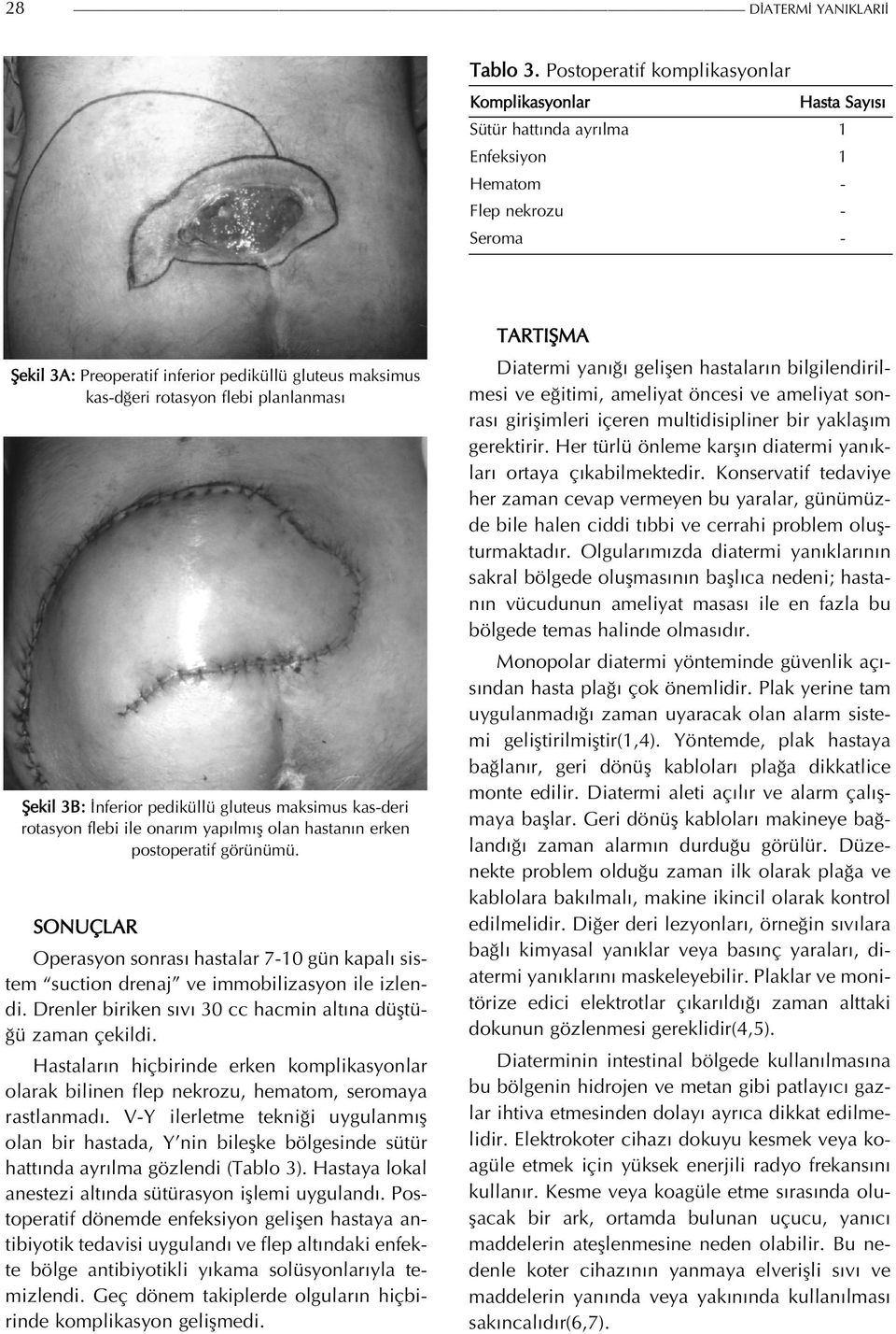 rotasyon flebi planlanması Şekil 3B: İnferior pediküllü gluteus maksimus kas-deri rotasyon flebi ile onarım yapılmış olan hastanın erken postoperatif görünümü.