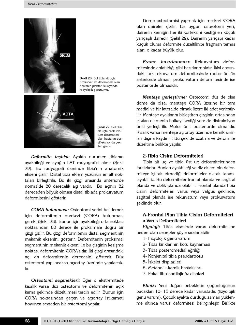 Þekil 28: Sol tibia alt uçta prokurvatum deformitesi olan hastanýn plantar fleksiyonda radyolojik görünümü.