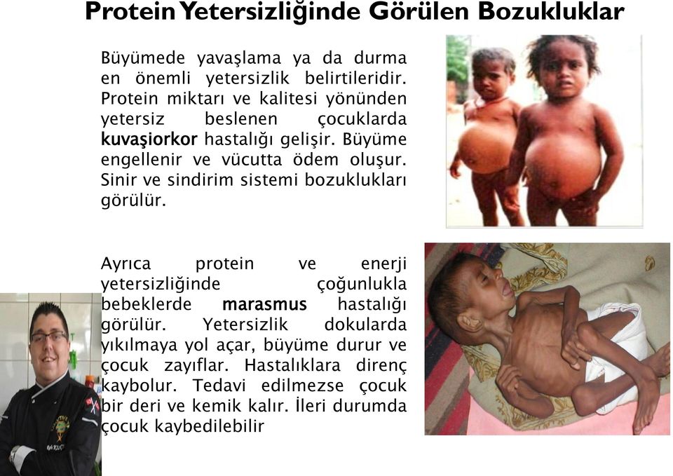 Sinir ve sindirim sistemi bozuklukları görülür. Ayrıca protein ve enerji yetersizliğinde çoğunlukla bebeklerde marasmus hastalığı görülür.