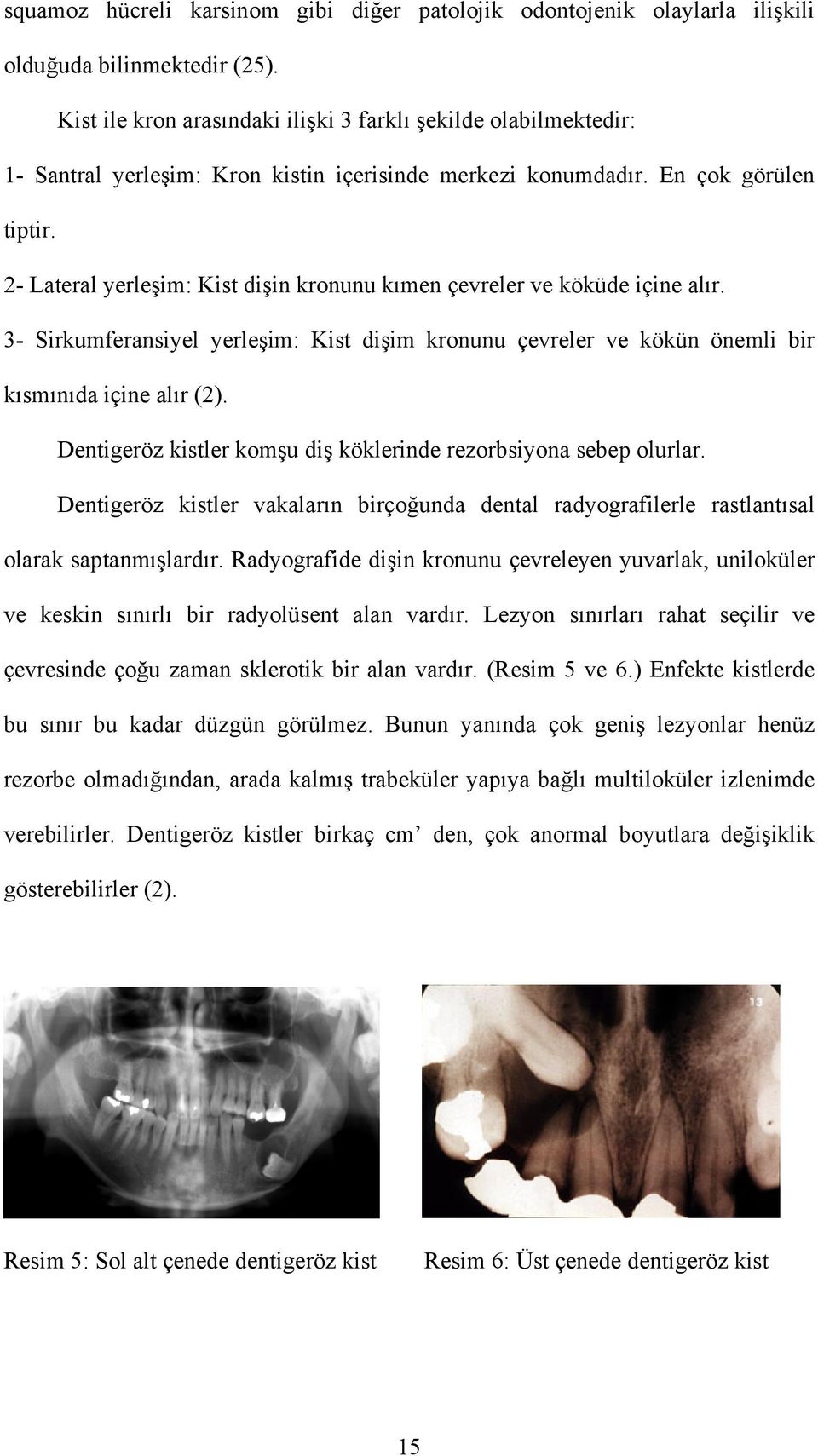 2- Lateral yerleşim: Kist dişin kronunu kımen çevreler ve köküde içine alır. 3- Sirkumferansiyel yerleşim: Kist dişim kronunu çevreler ve kökün önemli bir kısmınıda içine alır (2).