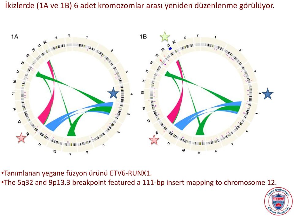 Tanımlanan yegane füzyon ürünü ETV6-RUNX1.