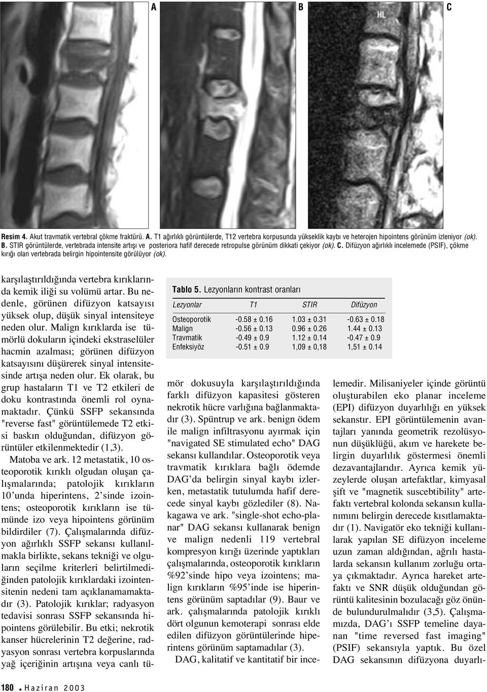 Difüzyon a rl kl incelemede (PSIF), çökme k r olan vertebrada belirgin hipointensite görülüyor (ok). Tablo 5. Lezyonlar n kontrast oranlar Lezyonlar T1 STIR Difüzyon Osteoporotik -0.58 ± 0.16 1.