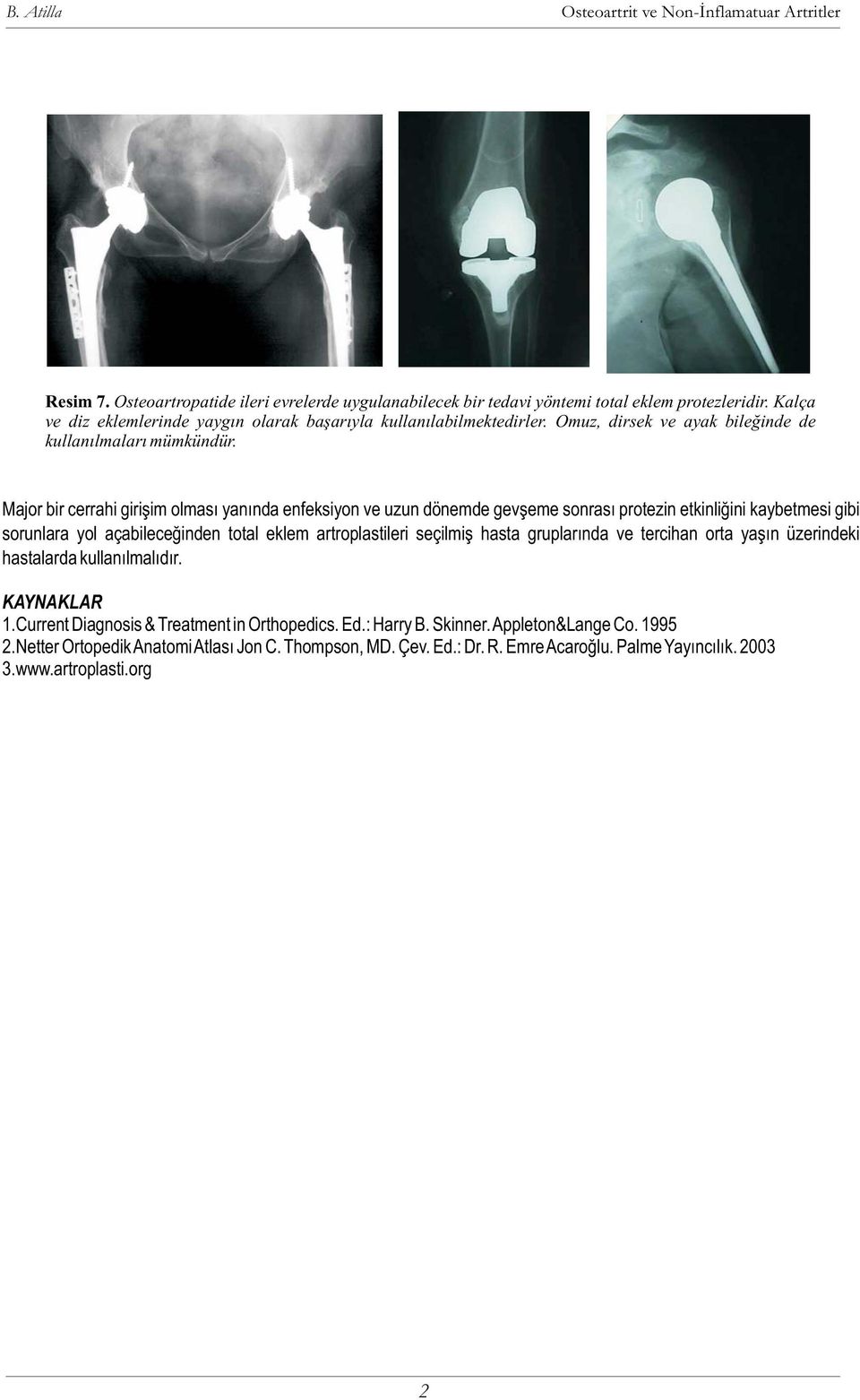 Major bir cerrahi giriþim olmasý yanýnda enfeksiyon ve uzun dönemde gevþeme sonrasý protezin etkinliðini kaybetmesi gibi sorunlara yol açabileceðinden total eklem artroplastileri