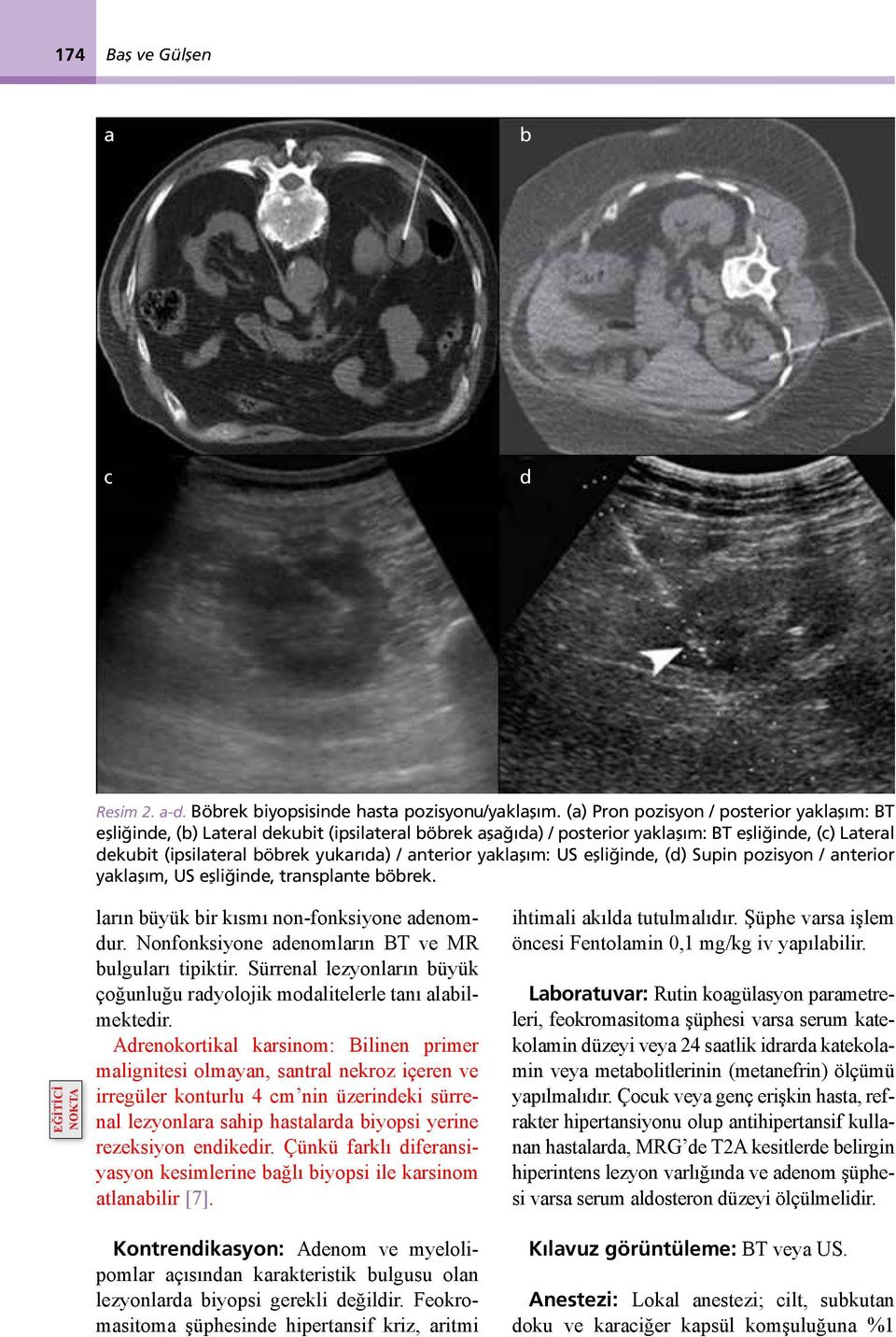 yaklaşım: US eşliğinde, (d) Supin pozisyon / anterior yaklaşım, US eşliğinde, transplante böbrek. EĞİTİCİ NOKTA ların büyük bir kısmı non-fonksiyone adenomdur.