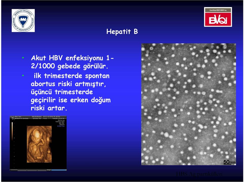 ilk trimesterde spontan abortus riski