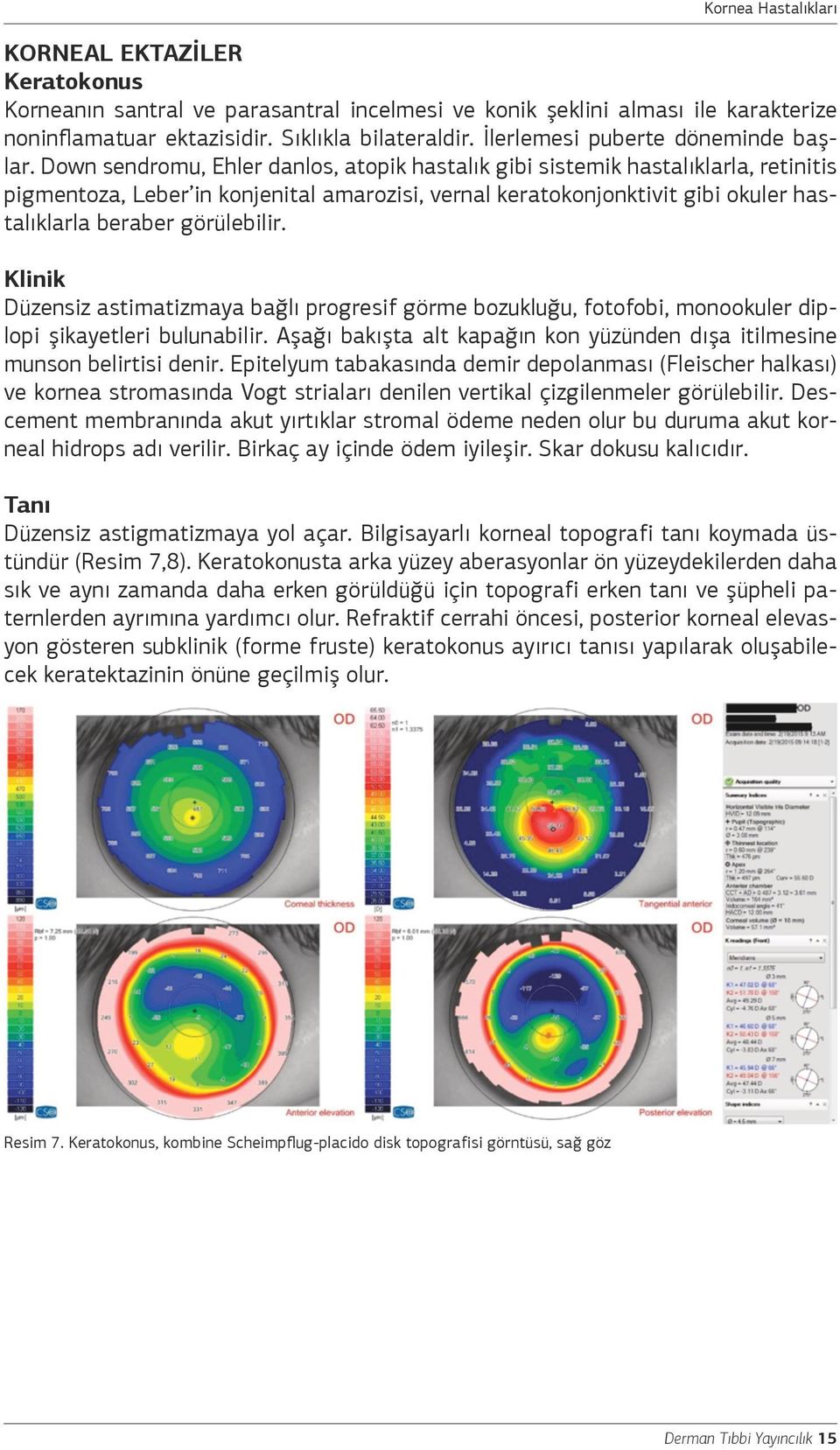 Klinik Düzensiz astimatizmaya bağlı progresif görme bozukluğu, fotofobi, monookuler diplopi şikayetleri bulunabilir. Aşağı bakışta alt kapağın kon yüzünden dışa itilmesine munson belirtisi denir.