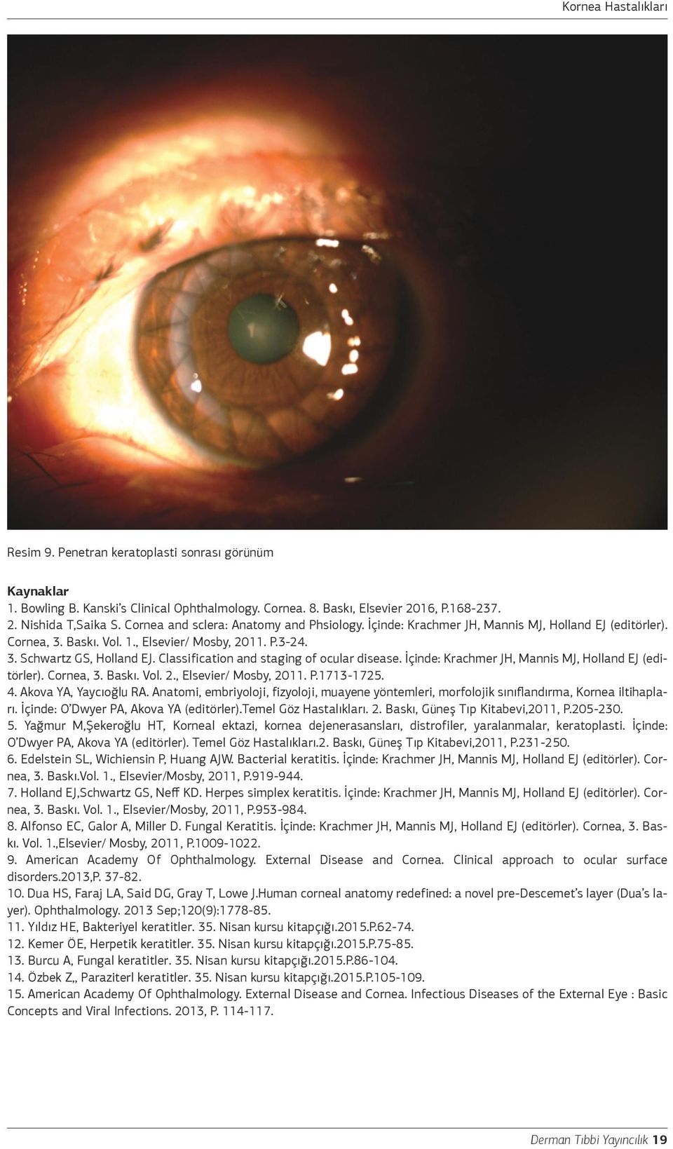 Classification and staging of ocular disease. İçinde: Krachmer JH, Mannis MJ, Holland EJ (editörler). Cornea, 3. Baskı. Vol. 2., Elsevier/ Mosby, 2011. P.1713-1725. 4. Akova YA, Yaycıoğlu RA.