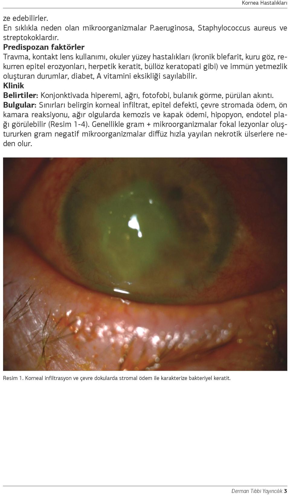 oluşturan durumlar, diabet, A vitamini eksikliği sayılabilir. Klinik Belirtiler: Konjonktivada hiperemi, ağrı, fotofobi, bulanık görme, pürülan akıntı.