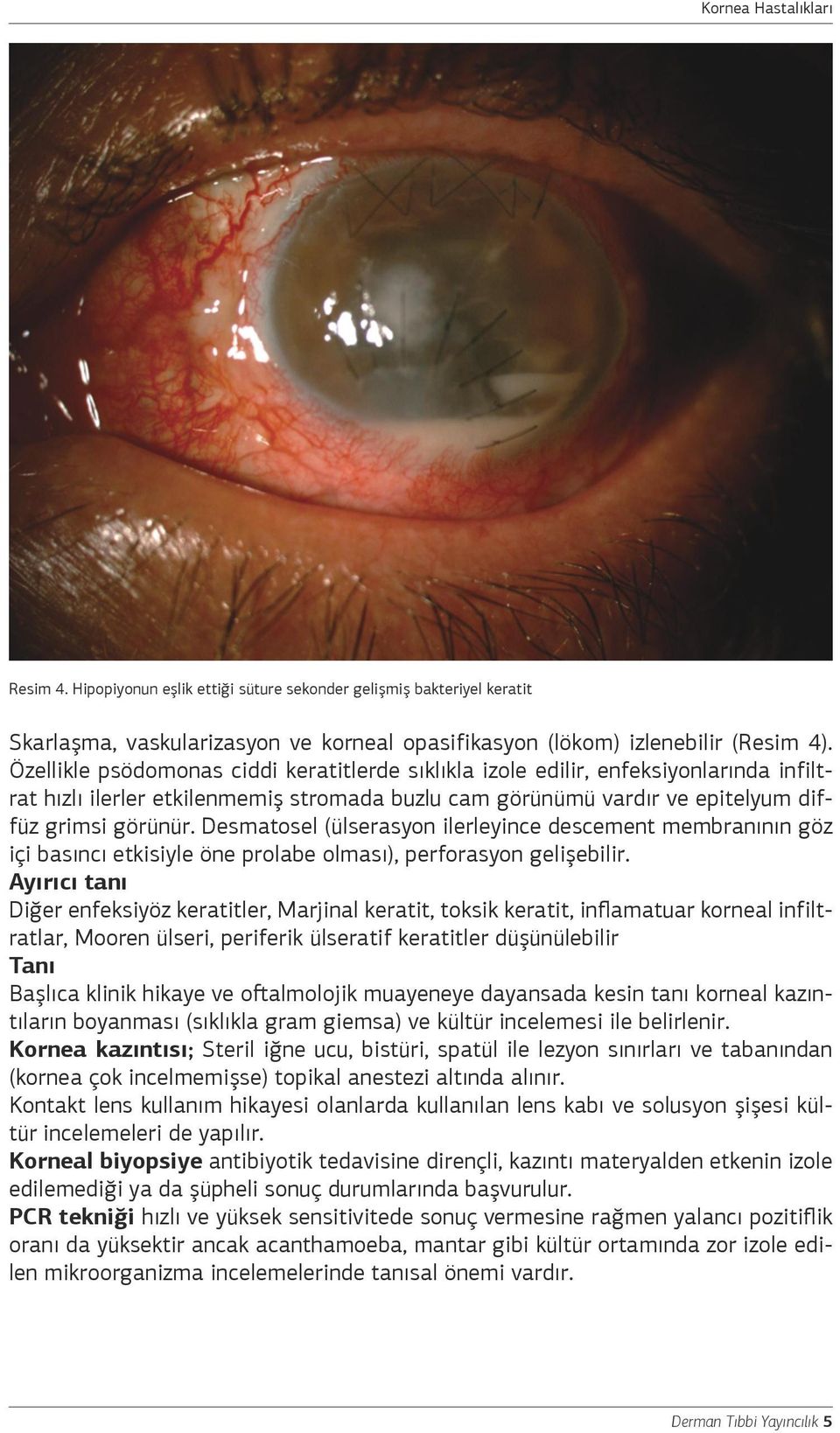 Desmatosel (ülserasyon ilerleyince descement membranının göz içi basıncı etkisiyle öne prolabe olması), perforasyon gelişebilir.