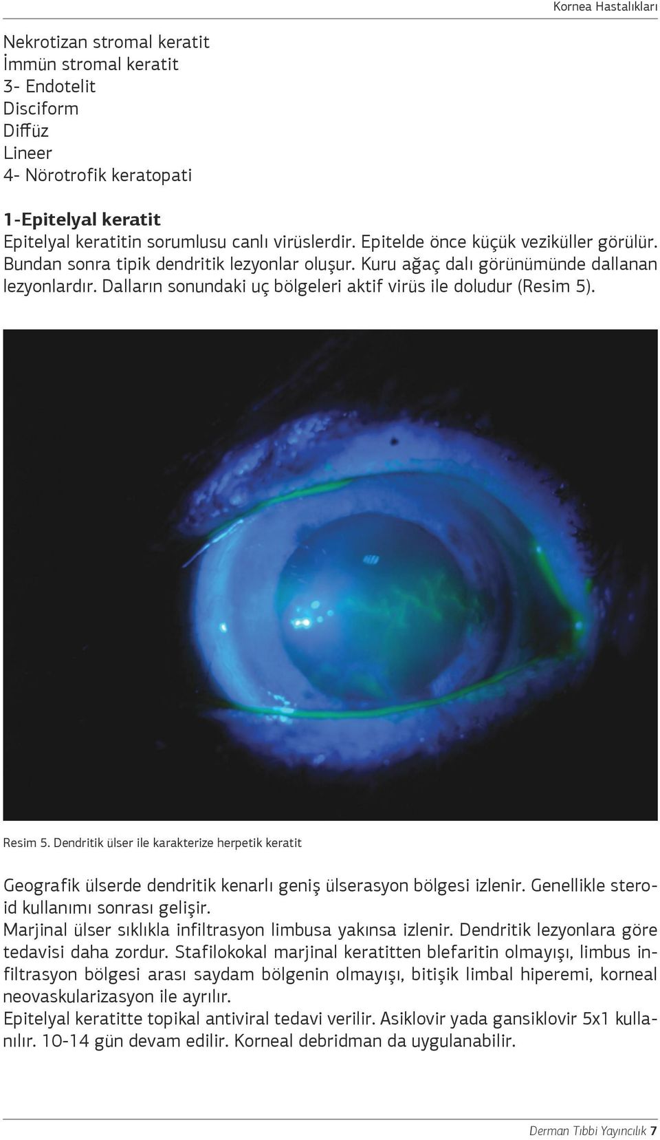 Dalların sonundaki uç bölgeleri aktif virüs ile doludur (Resim 5). Resim 5. Dendritik ülser ile karakterize herpetik keratit Geografik ülserde dendritik kenarlı geniş ülserasyon bölgesi izlenir.